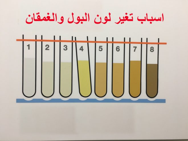 اسباب تغير لون البول